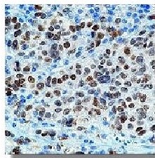 "
Immunohistochemical
staining using
microphthalmia antibody
on formalin fixed, paraffin
embedded human
melanoma."